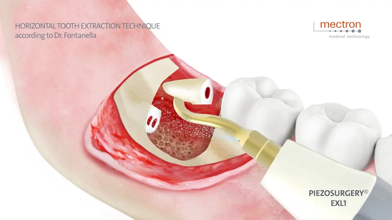 PIEZOSURGERY - Dr. Fabrizio Fontanella - Horizontal tooth extraction technique PIEZOSURGERY - Dr. Fabrizio Fontanella - Horizontal tooth extraction technique