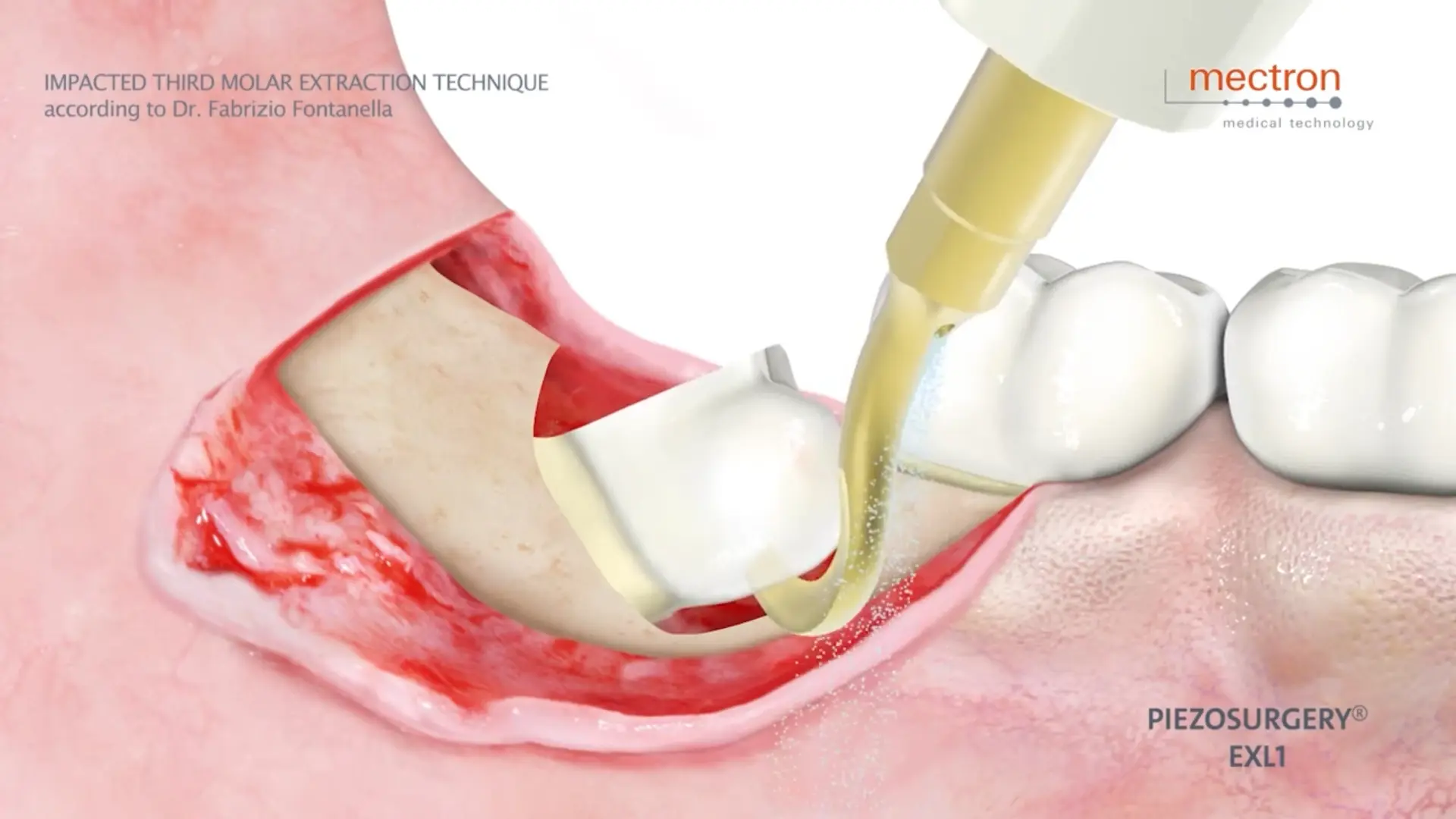 PIEZOSURGERY - Dr. Fabrizio Fontanella - Impacted third molar extraction technique PIEZOSURGERY - Dr. Fabrizio Fontanella - Impacted third molar extraction technique