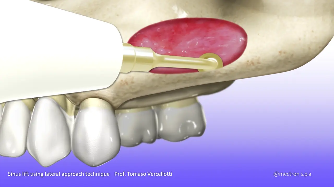 PIEZOSURGERY - Prof. Tomaso Vercellotti - Sinus lift using lateral approach technique by PIEZOSURGERY - Prof. Tomaso Vercellotti - Sinus lift using lateral approach technique by