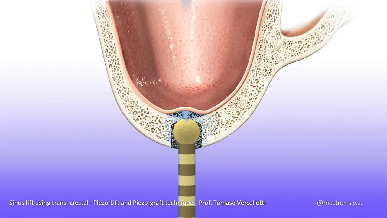 PIEZOSURGERY - Prof. Tomaso Vercellotti - Sinus lift using trans- crestal approach - Piezo-Lift and Piezo-graft technique PIEZOSURGERY - Prof. Tomaso Vercellotti - Sinus lift using trans- crestal approach - Piezo-Lift and Piezo-graft technique