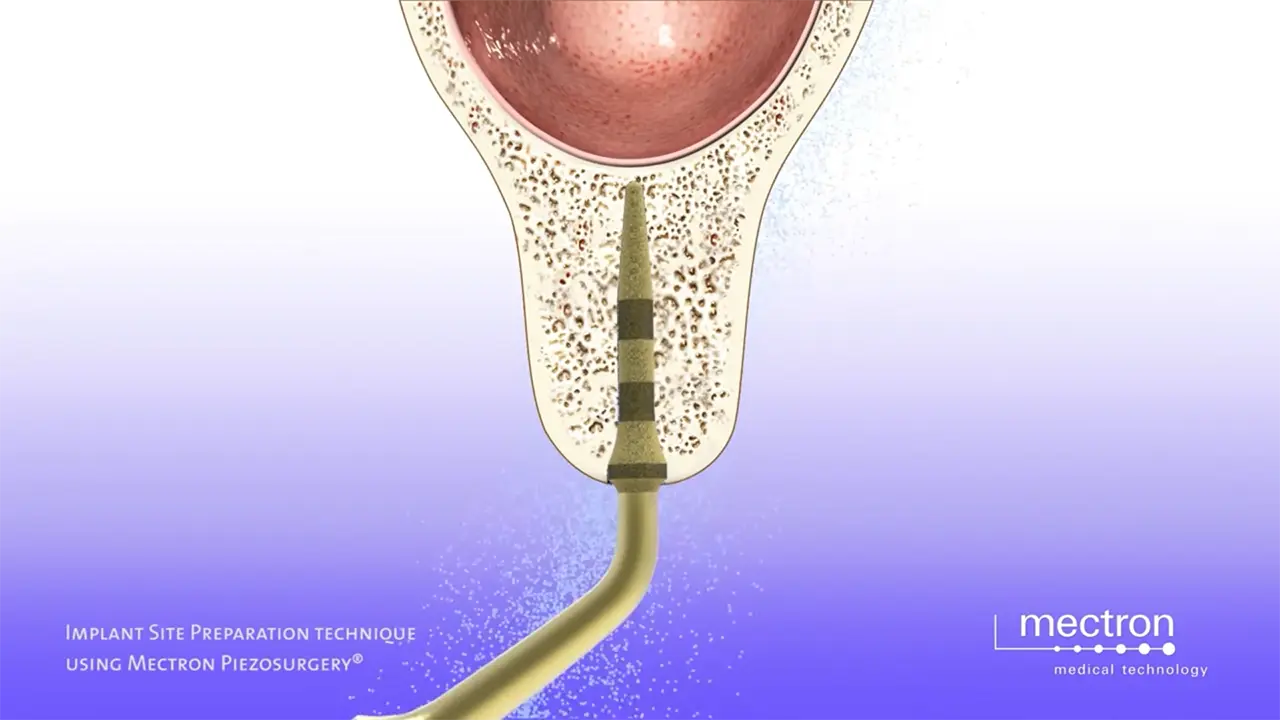 PIEZOSURGERY - Prof. Tomaso Vercellotti - Ultrasonic preparation of the implant site - UISP technique