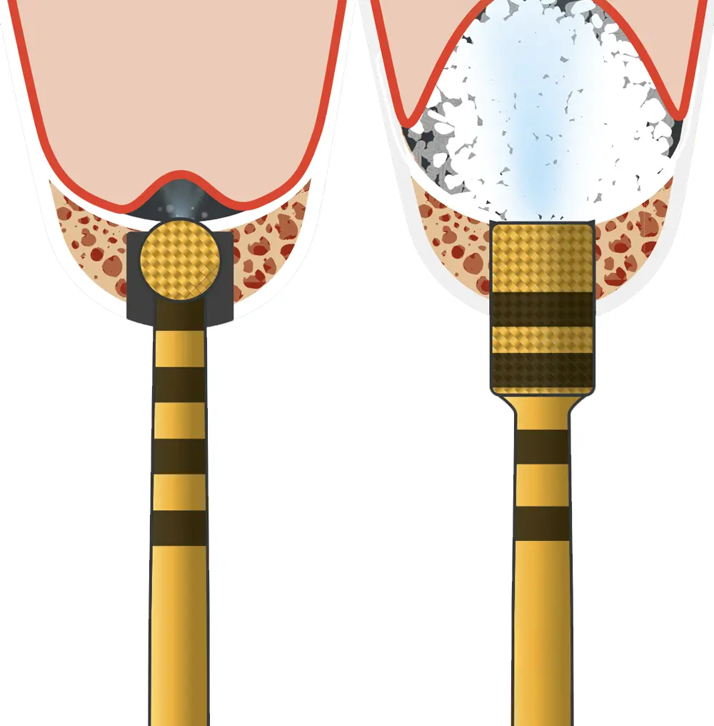 Sinus piezo-lift technique Sinus piezo-lift technique
