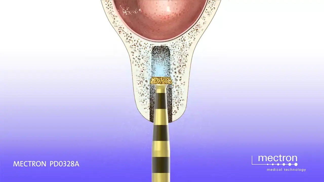 Implant Site Preparation with PiezoDrill PIEZOSURGERY - Dr. Fabrizio Fontanella - Horizontal tooth extraction technique