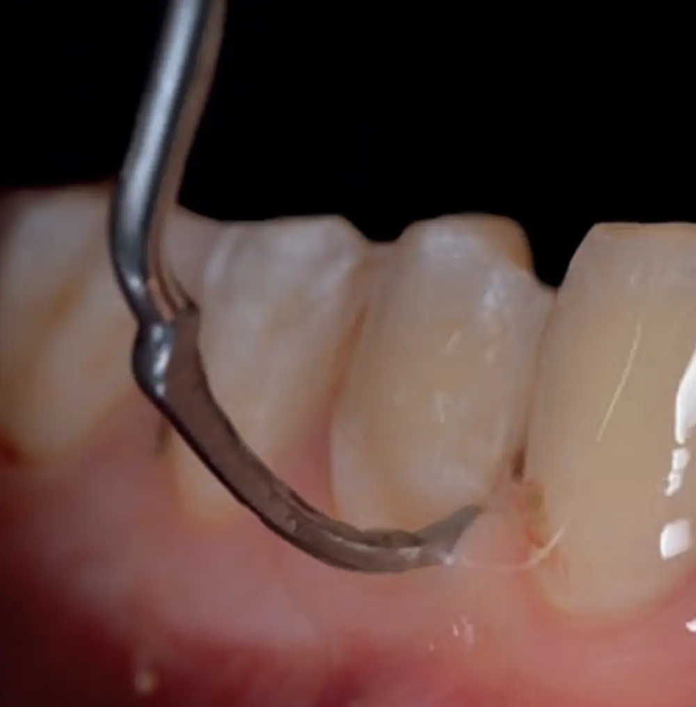 Ultrasonic cervical finishing – atraumatic and precise