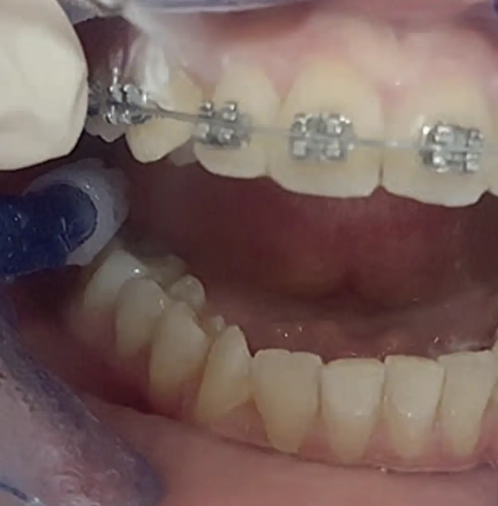 Ultrasonic cervical finishing – atraumatic and precise